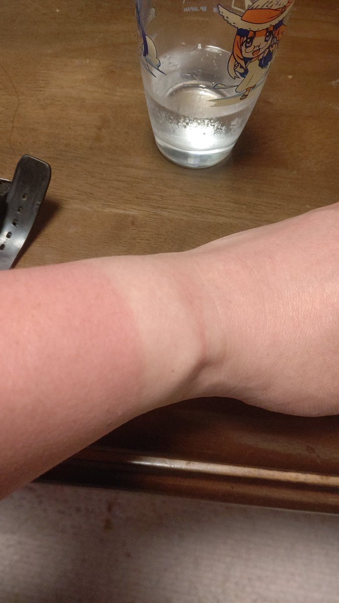 今日の日焼けで腕時計の跡がくっきり！ヒリヒリして寝られない、けど、明日は早いので早く寝たい。のび太並みに寝るのに手間... [おもちゃの平野【Twitter】]